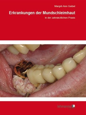 cover image of Erkrankungen der Mundschleimhaut